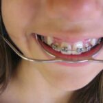 Брекеты в Иваново: современные технологии и индивидуальный подход