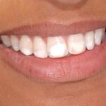 Белый зубной налет: норма или проблема?