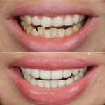 Как выбрать виниры для естественной улыбки: руководство по созданию идеального образа